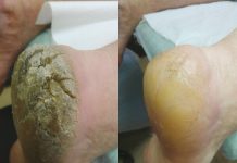 Pękające pięty! Hiperkeratozy stóp szczególnie dokuczające latem