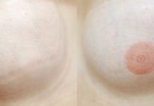 Mikropigmentacja medyczna piersi. Cz. II Rekonstrukcja otoczki brodawki sutkowej po mastektomii