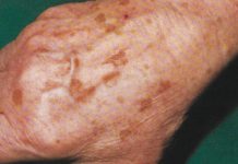 Leczenie zaburzeń barwnikowych skóry związanych z wiekiem. Przegląd metod