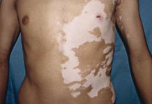 Zmiany skórne w bielactwie nabytym – możliwości terapeutyczne