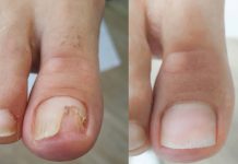 Terapia onycholizy w gabinecie podologicznym