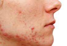 Nowoczesne terapie w leczeniu trądziku późnego wykorzystywane w kosmetologii
