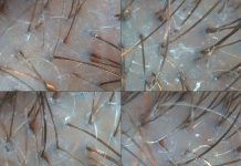 Mezoterapia igłowa skóry głowy osoczem bogatopłytkowym jako metoda redukcji nadmiernego wypadania włosów