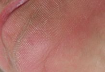 Zastosowanie laserów w terapii wybranych problemów skórnych. Przegląd metod