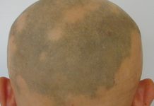 Karboksyterapia w terapii łysienia i wypadania włosów