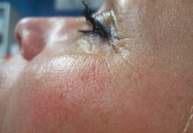 Korekcja zmarszczek na twarzy