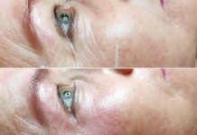 Nieablacyjna laserowa regeneracja skóry