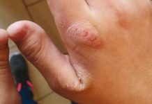 Dermatozy wywołane przewlekłym działaniem czynników mechanicznych