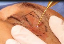 Zastosowanie technologii plazmy w blefaroplastyce