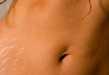 Porównanie skuteczności serii zabiegów mikrodermabrazji diamentowej i kwasu glikolowego w terapii rozstępów w fazie zanikowej