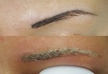 Remover kontra laser jako skuteczna metoda usuwania makijażu permanentnego