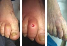 Wpływ wybranych deformacji na stan skóry i paznokci stóp