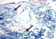 Wielokierunkowe działanie zabiegu karboksyterapii w walce z mechanizmami wywołującymi cellulit