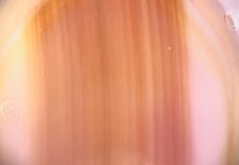 Zmiany barwnikowe paznokci. Diagnostyka różnicowa i postępowanie