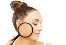 Cera naczyniowa Czy zawsze oznacza początek trądziku różowatego?