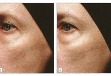 Retinoidy. Mechanizm działania, właściwości oraz zakres stosowania w dermatologii i kosmetologii