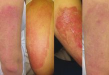 Epidermoliza jako powikłanie po peelingu 45% kwasem pirogronowym. Opis przypadku