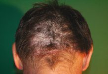 Łuszczyca – pielęgnacja i postepowanie w gabinecie kosmetycznym