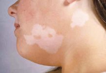 Bielactwo. Etiopatogeneza, obraz kliniczny oraz współczesne możliwości terapeutyczne