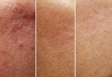 Trądzik różowaty – metody terapii oraz ocena skuteczności zastosowania kwasu azelainowego i laktobionowego