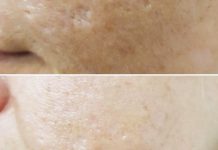 Zastosowanie bipolarnej radiofrekwencji mikroigłowej w kosmetologii, ze szczególnym uwzględnieniem redukcji blizn potrądzikowych