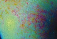 Demodekoza – charakterystyka i objawy oraz pielęgnacja skóry zainfekowanej z zastosowaniem kwasu migdałowego