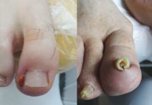 Wrastający paznokieć. Jaką pomoc uzyskasz w gabinecie podologicznym?