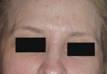 Rola i działanie kwasu laktobionowego w przebiegu wybranych chorób skórnych