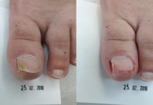 Terapia podologiczna w przypadku grzybicy dermatofitowej paznokci