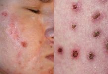 Samouszkodzenia skóry. Rola kosmetologa w diagnostyce i terapii