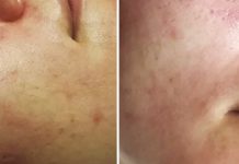 Wykorzystanie wybranych kwasów organicznych w niwelowaniu blizn potrądzikowych