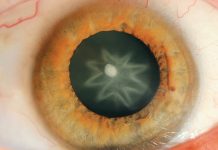 Zaćma pourazowa i towarzyszące jej zmiany w narządzie wzroku