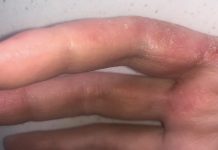 Zjawisko alergii w gabinecie kosmetologicznym