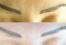 Laser Nd-Yag typu Q-Switch. Najbardziej niedoceniany laser w gabinetach kosmetycznych