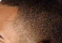 Najczęstsze problemy pacjenta trychologicznego – choroby skóry głowy