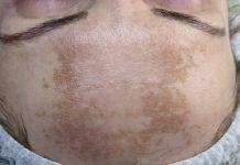 Wpływ melanogenezy na powstawanie przebarwień