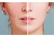 Postępowanie w terapii trądziku różowatego Cz. I – Profesjonalna pielęgnacja gabinetowa