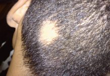 Łysienie plackowate – podłoże oraz leczenie