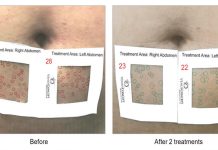Porównanie rezultatów użycia lasera diodowego w dwóch trybach pracy. Studium przypadku