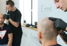 Leczenie oraz kamuflaż łysienia