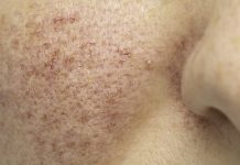 Postępowanie w terapii trądziku różowatego. Część II – Zalecenia pielęgnacji domowej