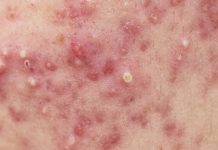 Dysfunkcje seksualne a leczenie izotretynoiną