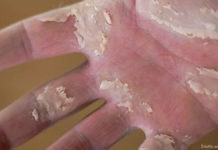 Erytrodyzestezja dłoniowo-podeszwowa indukowana chemioterapią. Rekomendacje dla postępowania kosmetologicznego