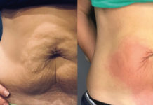 Ciepło – zimno… czyli szok termiczny