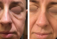 Radiofrekwencja mikroigłowa