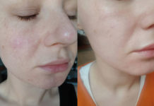 Wpływ zabiegu nanobrazji na poprawę estetyki i prewencję starzenia się skóry twarzy. Opis przypadku