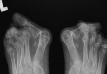 Reumatoidalne zapalenie stawów w obrębie kończyny dolnej – opis przypadku