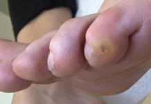 Wysokie obcasy najczęstszą przyczyną nabytych deformacji i dolegliwości bólowych w obrębie stóp u kobiet