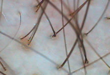 Wypadanie włosów w chorobie Hashimoto