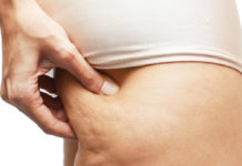 Cellulit – jak zapobiegać i „leczyć”. Wpływ stylu życia oraz przegląd metod „leczenia”